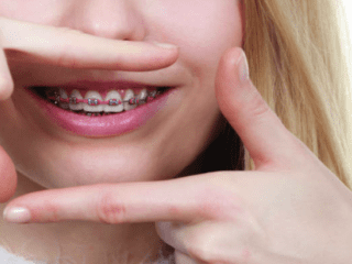 Aparat na zęby Gabinet So! Smile Ortodoncja i stomatologia Kielce
