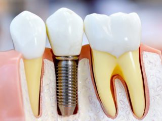Implant zęba Gabinet So! Smile Ortodoncja i stomatologia Kielce