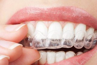 Apart na zęby Gabinet So! Smile Ortodoncja i stomatologia Kielce